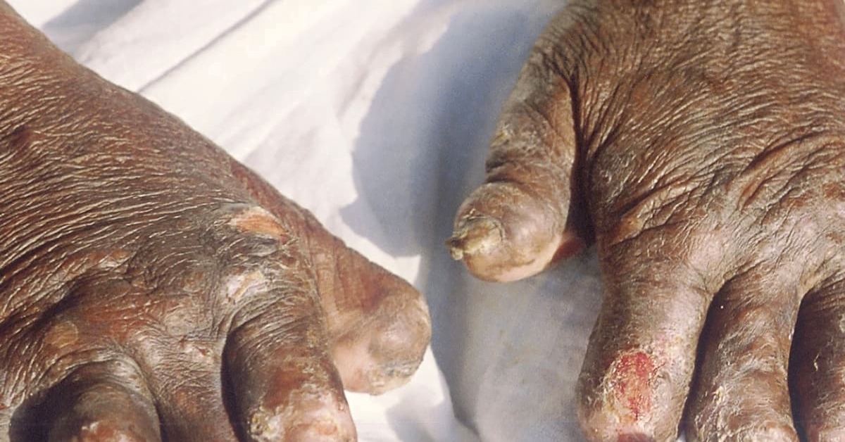 Leprosy Resurgence: Florida's Alarming Outbreak?