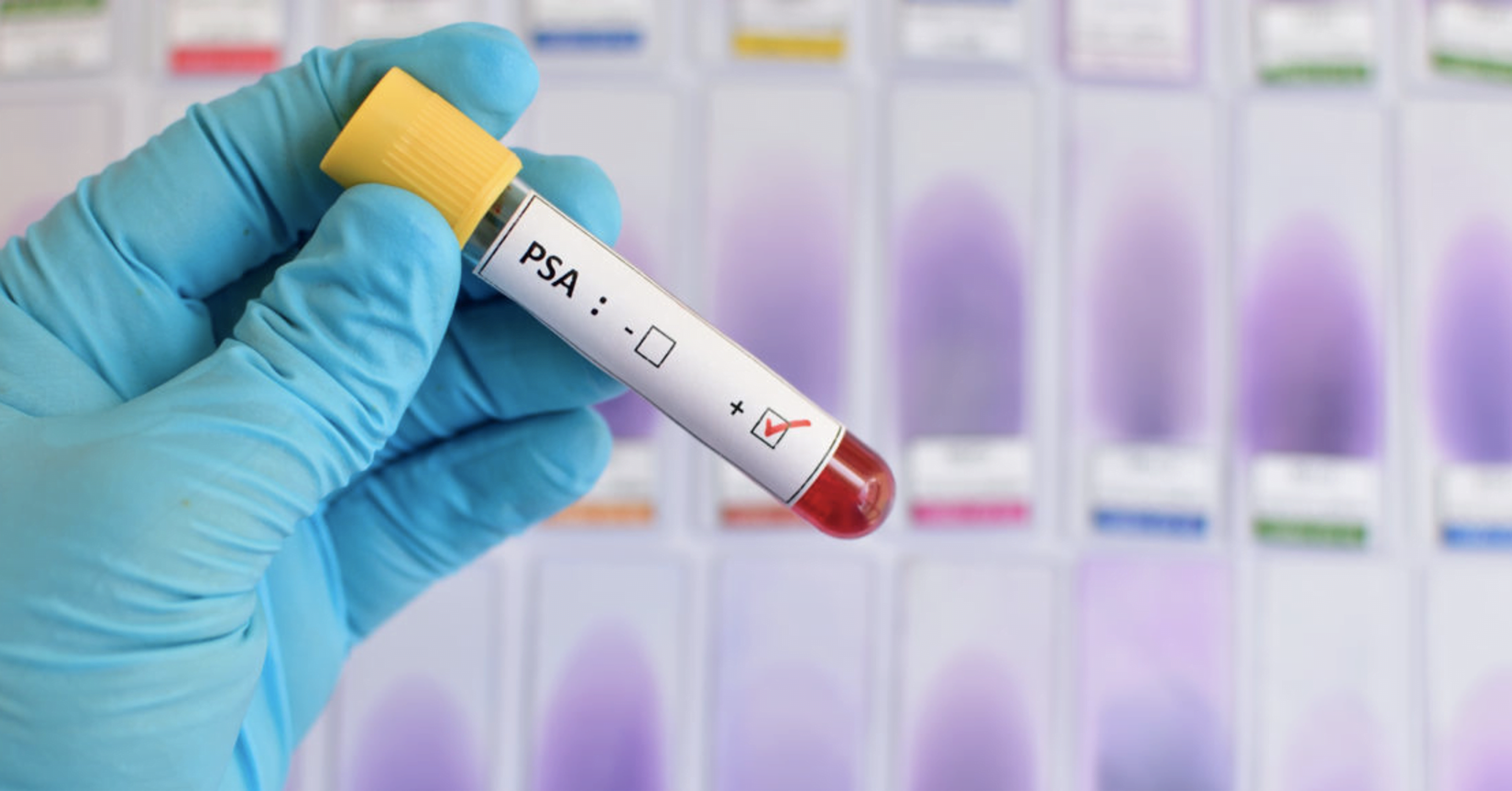 The Controversy of Prostate Cancer Screening
